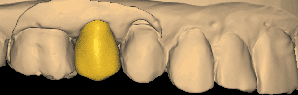Single-Unit Premolar Crown CAD Design